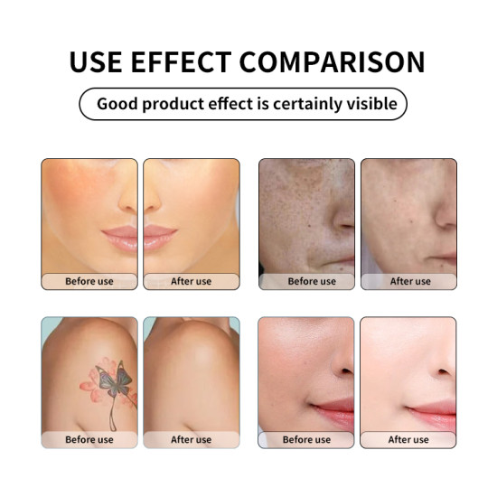 A0514 2023 New arrival black picosecond laser tattoo removal machine laser beauty machine for face