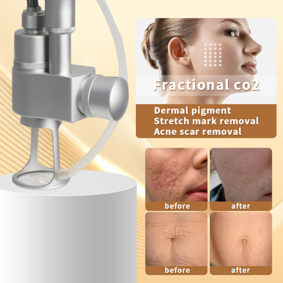 2023 Hot Sale Co2 Fractional Laser Machine Scar Stretch Removal  2023 Hot Sale Co2 Fractional Laser Machine Scar Stretch Removal