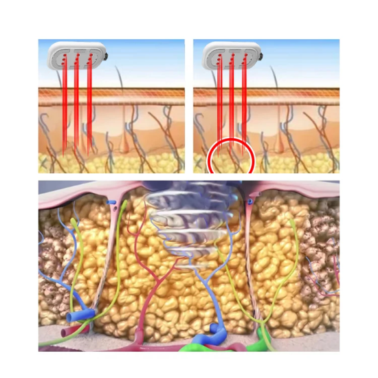 A0928 New upgrade lipo pads ems rf red light therapy device full body 660nm 850nm weight loss cellulite reduction machine